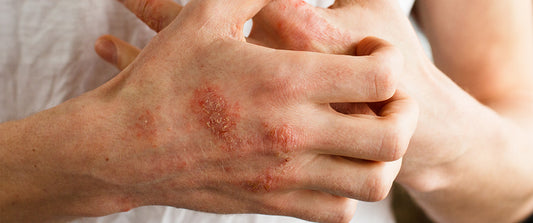 Understanding Eczema - Preventing Flare-Ups