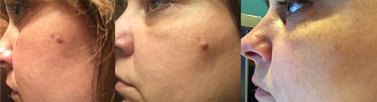 Remove those pesky mole growths!